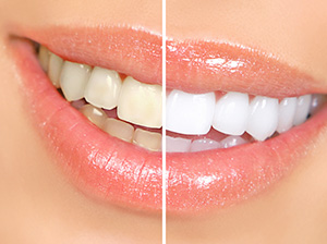 Teeth Whitening