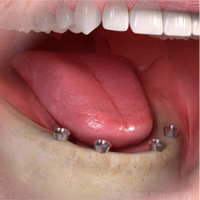 Denture Retained Implants