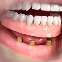 Denture Retained Implants