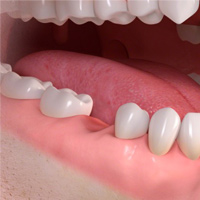 Individual Tooth Replacement