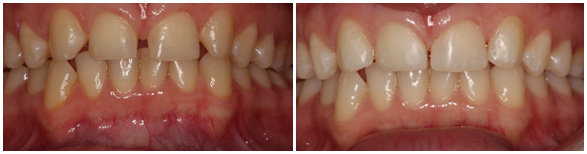 Composite Bonding