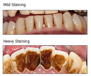 Tips to help avoid stained teeth